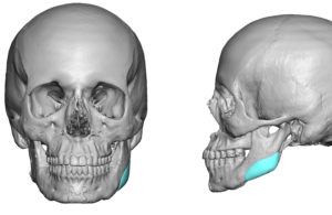 Custom Jaw Angle Implant for Asymmetry Dr Barry Eppley Indianapolis