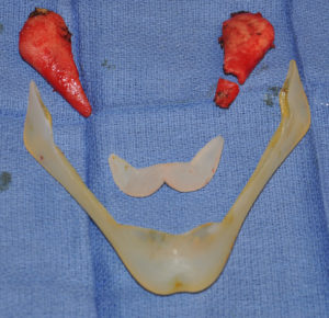 Custom Jawline Implant Replacement comparison Dr Barry Eppley Indianapolis