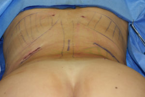 Effects of Posterior Rib Removal for Waistline Narrowing Dr Barry Eppley Indianapolis