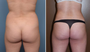 Female Liposuction results back view Dr Barry Eppley Indianapolkis