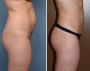 Female Liposuction results side view Dr Barry Eppley Indianapolis