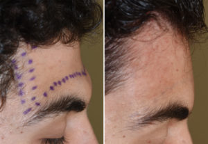 Forehead Augmentation with PMMA intraop result Dr Barry Eppley Indianapolis
