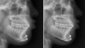 Inferior Border Shave afetr Setback Sliding genipoplasty x-ray Dr Barry Eppley Indianapolis