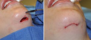 Inferior Mandibular Border Reduction intraop Dr Barry Eppley Indianapolis