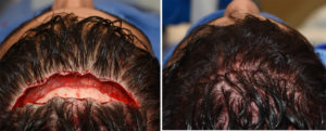 Limited Frontal Cranioplasty incision and closure Dr Barry Eppley Indianapolis