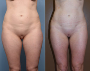 Liposculpture results front view Dr Barry Eppley Indianapolis