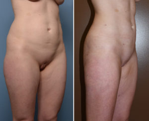 Liposculpture results oblique view Dr Barry Eppley Indianapolis