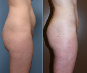 Liposculpture results side view Dr Barry Eppley Indianapolis