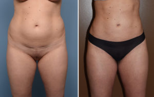 Liposuction results front view Dr Barry Eppley Indianapolis