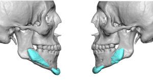 Malpositioned Jaw Implants