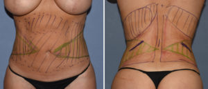 Maxumum Waistline Reduction Surgery with Rib Rermovals Dr Barry Eppley Indianapolis