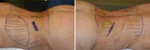 Posterior Rib Removal incisions Dr Barry Eppley Indianbapolis
