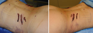 Posterior Rib Removal specimens Dr Barry Eppley Indianapolis