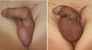 Remove and Replace Testicular Implant result Dr Barry Eppley Indianapolis