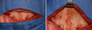 Sagittal Crest Reduction intraop Dr Barry Eppley Indianapolis