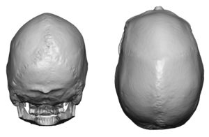 Sagittal Crest Skull Deformity 2 Dr Barry Eppley Indianapolis