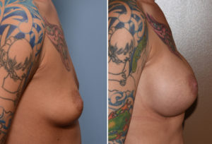 Tear drop Breast Implants result side view Dr Barry Eppley Indianapolis