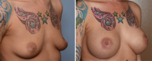 Teardrop Breast Implants result results oblique view Dr Barry Eppley Indianapolis