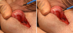 Testicular Implant Capsulotomy Dr Barry Eppley Indianapolis