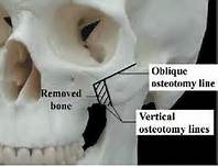 cheekbone reduction osteotomies Dr Barry Eppley Indianapolis