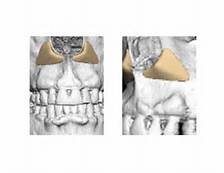 deep pyriform space implant dr barry eppley indianapolis