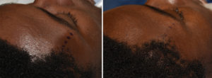 Anterior Temporal Muscle Reduction right side Dr Barry Eppley Indianapolis
