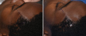 Anterior Temporal Reduction left side Dr Barry Eppley Indianapolis