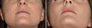 Buccal Lipectomies and Perioral Liposuctgion results submental view Dr Barry Eppley Indianapolis