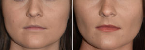 Buccal Lipectomies and Perioral Liposuction results Dr Barry Eppley Indianapolis