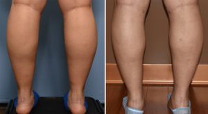 Calf and Ankle Liposuction result back view Dr Barry Eppley Indianapolis