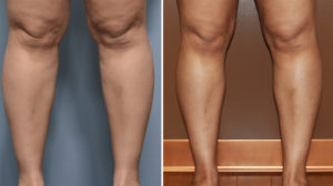 Calf and Ankle Liposuction results front view Dr Barry Eppley Indianapolis