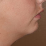 Chin Deficiency after Sliding Genioplasty