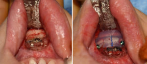 Chin Implant after Sliding Genioplasty intraop Dr Barry Eppley Indianapolis