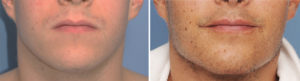 Custom Jawline Implant result Indianapolis Dr Barry Eppley