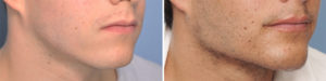 Custom Jawline Implant result oblique view Indianapolis Dr Barry Eppley