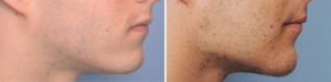 Custom Jawline Implant result side view Indianapolis Dr Barry Eppley