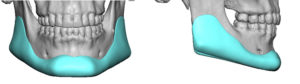 Custom Jawloine Implant design Indianapolis Dr Barry Eppley