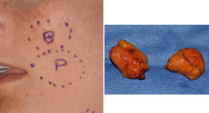 Female Buccal Lipectomy and Periorall Liposuction intraop Dr Barry Eppley Indianapolis