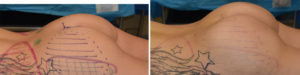 Female Buttock Implants intraop result left side view Dr Barry Eppley Indianapolis