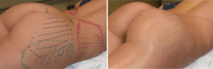 Female Buttock Implants intraop result right oblique view Dr Barry Eppley Indianapolis