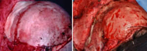 Hydroxyapatite Cement in Craniofacial Surgery Long Term Result left oblioque view Dr Barry Eppley Indianapolis