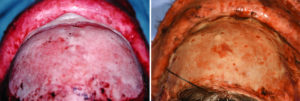 Hydroxyapatite Cement in Craniofacial Surgery Long Term Result top view Dr Barry Eppley Indianapolis