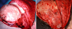 Hydroxyapatite Cement inj Craniofacial Surgery Long Ternm result obloique view Dr Barry Epplay Indianapolis