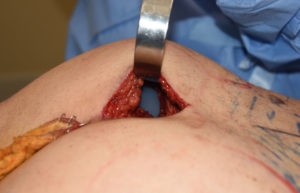 Intramuscular Buttock Implant Placement Dr Barry Eppley Indianapolis