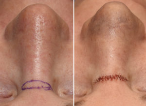 Nasal Lift intraop Dr Barry Eppley Indianapolis