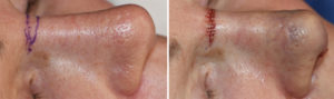 Nasal Lift intraop side view Dr Barry Eppley Indianapolis