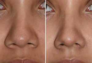 Nostril Narrowing result front view Dr Barry Eppley Indianapolis