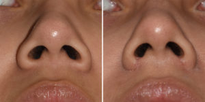 Nostril Narrowing result submental view Dr Barry Eppley Indianapolis