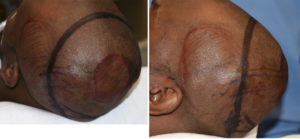 Occipital Skull Reduction design Dr Barry Eppley Indianapolis