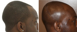 Occipital Skull Reduction result side view Dr Barry Eppley Indianapolis